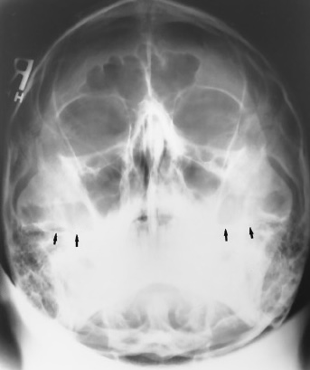 <p>What is this x-ray demonstrating?</p>