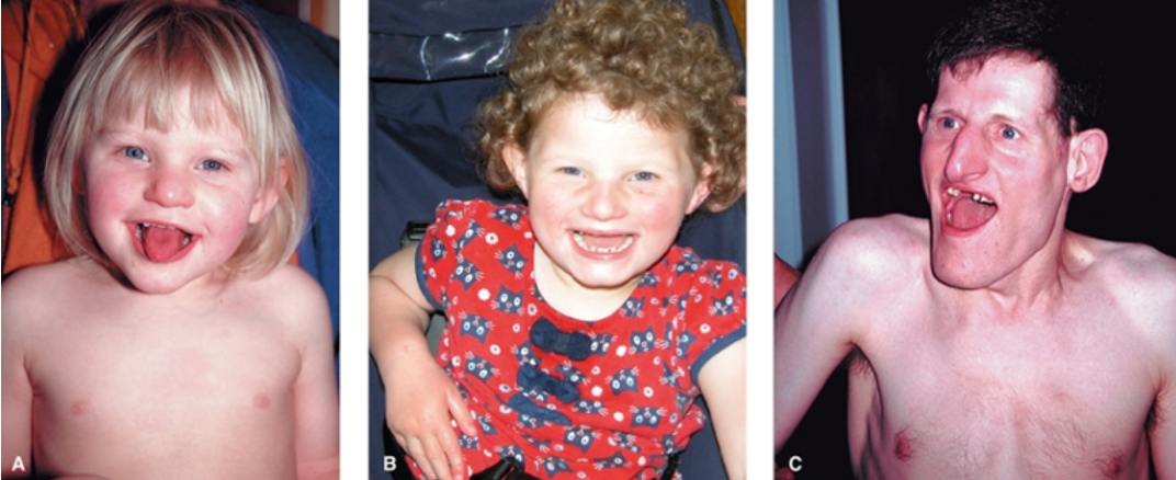 <p>Inappropriate laughter, convulsions, ataxia, severe learning difficulties</p>