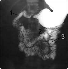 <ul><li><p>Dysphagia</p></li><li><p>Gastro-oesopghageal reflux (GERD)</p></li><li><p>Sensation of food sticking</p></li><li><p>Regurgitation of food</p></li><li><p>Stroke </p></li><li><p>Lap band or gastric sleeve surgery</p></li><li><p>?Foreign object</p></li><li><p>? Rupture - eg: sword swallower</p></li></ul><p></p>