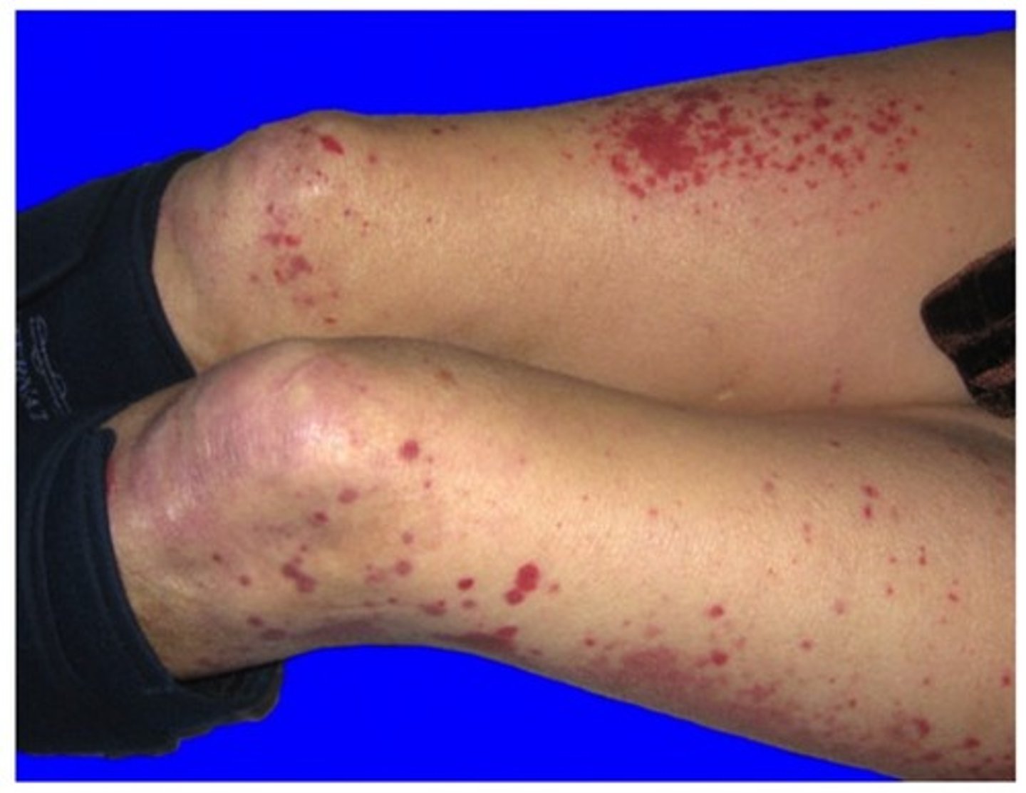 <p>Immune complexes that create a fluffy white precipitate after freezing donor serum</p><p>Can manifest as a reddish-purple rash + possible end-organ dysfunction</p>