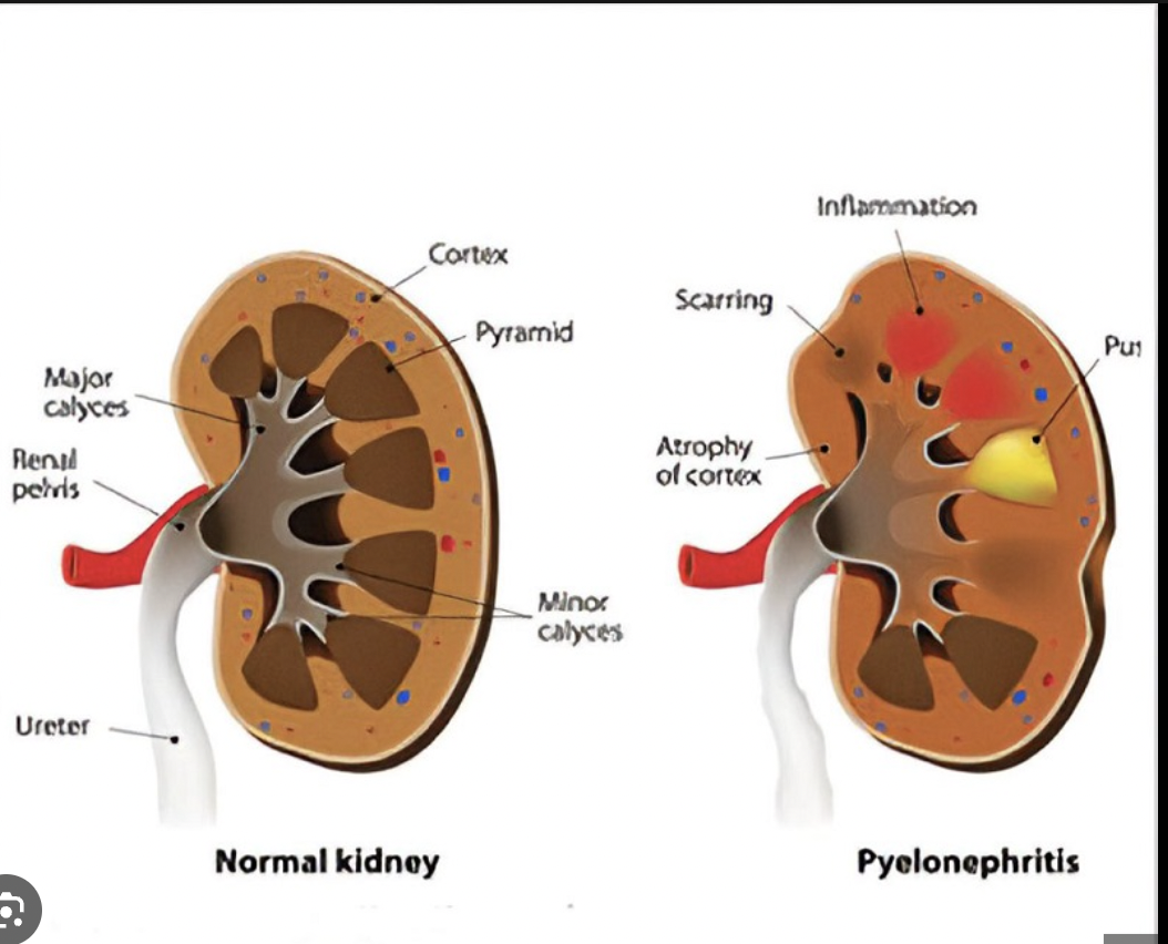 <p>Nephritis (nephr-)</p>