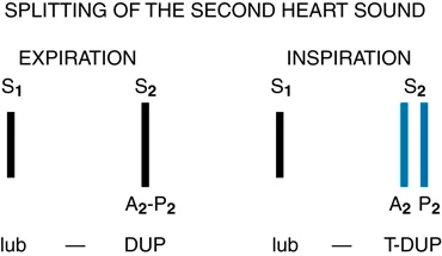 <p>Splitting of S2. A split S2 is a normal phenomenon that occurs toward the end of inspiration in some people.</p><p>(closure of the aortic and pulmonic valves is nearly synchronous.)</p><p>Because of the effects of respiration on the heart described earlier, inspiration separates the timing of the two valves' closure, and the aortic valve closes 0.06 second before the pulmonic valve.</p><p>Instead of hearing DUP we hear a split sound T-DUP</p><p>During expiration, synchrony returns and the aortic and pulmonic components fuse together</p><p>A split S2 is heard only in the pulmonic valve area, the second left interspace.</p>