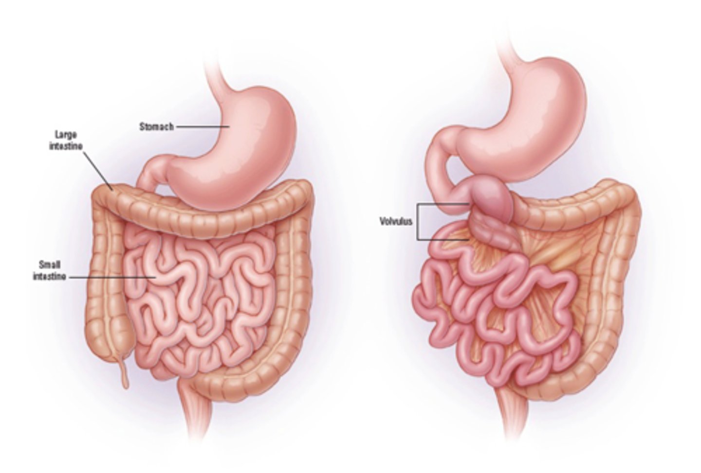 <p>Define Condition:</p><p>Congenital anatomic abnormality in which SI and LI are abnormally located in abdominal cavity</p><p>-Path: Intestines DO NOT rotate in counterclockwise direction during embryological development</p><p>&gt; Duodenum compressed by fibrous attachment tissue</p><p>&gt; Minimal attachment of intestines to posterior abdominal wall</p><p>&gt; Cecum in RUQ (instead of RLQ)</p><p>-Sx/PE:</p><p>&gt; Asx</p><p>&gt; Abdominal Discomfort</p><p>&gt; Vomiting (Bilious or Nonbilious, depending on obstruction location)</p><p>&gt; Poor Feeding</p><p>&gt; Poor Weight Gain</p><p>-Dx:</p><p>&gt; Routine Prenatal US</p>