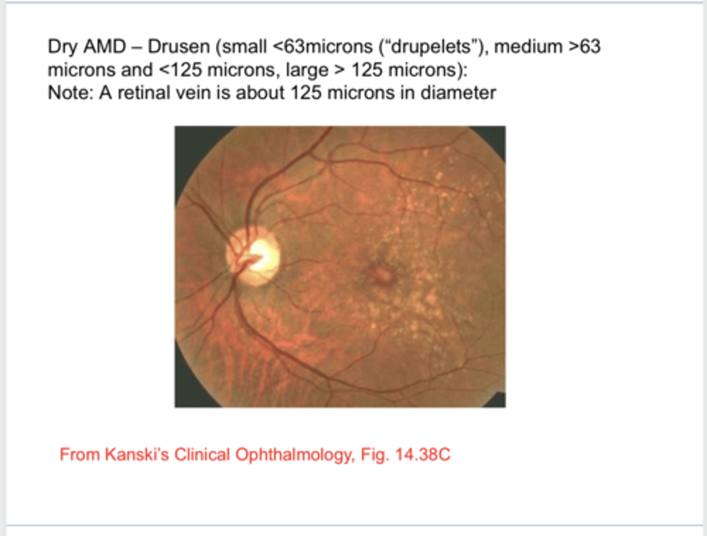 <p>Why are you concerned about large drusen?</p>