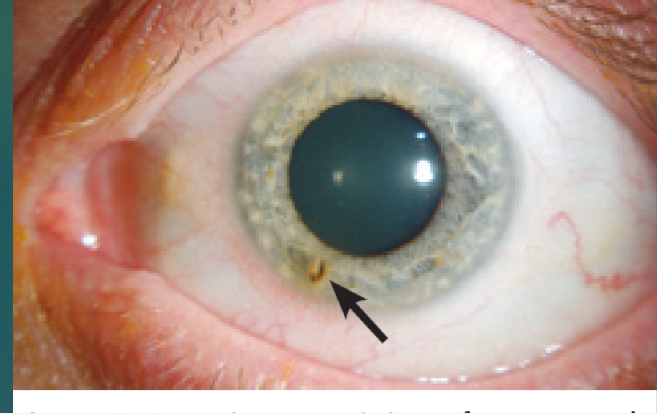 <p>Update tetanus</p><p>Topical anesthetic and or cycloplegic- comfort and exam (not usually necessary)</p><p>Topical anti-inflammatory eye drops- relieve pain, oral if not effective</p><p>FB remove with sterile cotton tipped applicator or tuberculin needle</p><p>“rust ring” after removal metal - remove rust ring</p><p>Once violated, cornea becomes susceptible to infection and prophylactic antibiotic drops used&nbsp;</p><p>Will heal on its own</p>