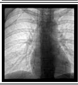 <p>tip in superior vena cava</p>