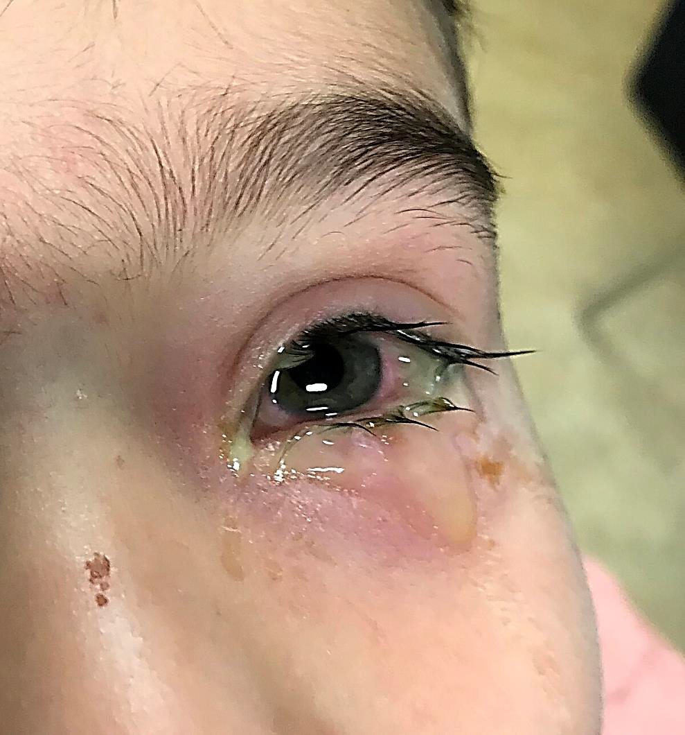 <p>Conjunctivitis</p><p>•Eye redness</p><p>•A discharge that forms a crust during the night that may prevent eyes from opening in the morning.</p>