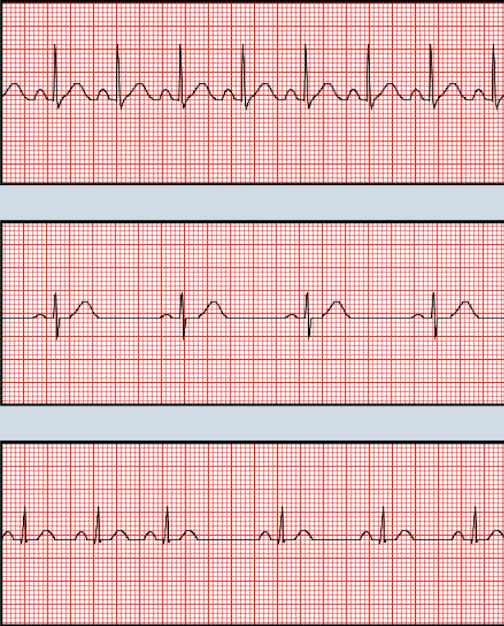 <p>Identify the heart rate type for each ECG</p>