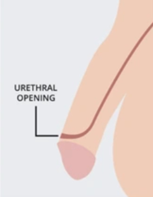 <p>a congenital condition where the urethra ends on the <strong>upper side</strong> of the penis.</p>