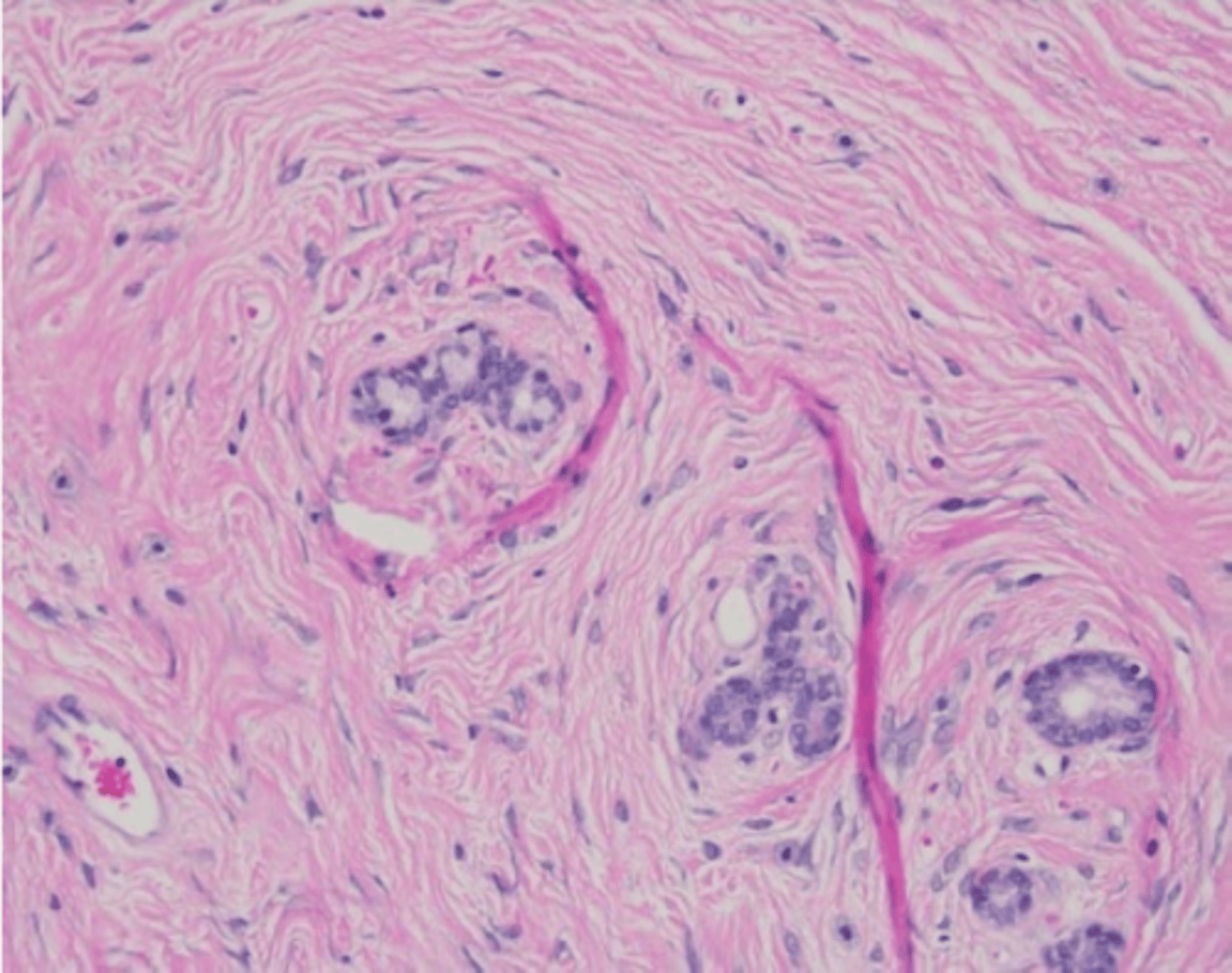 <p>This photomicrograph is from an aged Sprague-Dawley Rat. This neoplasm is histologically composed of two cell populations: well-differentiated mesenchymal cells (i.e. fibroblasts) associated with dense collagenous stroma and tubules. What is the most likely diagnosis?</p><p>A. Interstitial cell tumor</p><p>B. Mammary carcinoma</p><p>C. Large granular lymphocytic leukemia</p><p>D. Mammary fibroadenoma</p>
