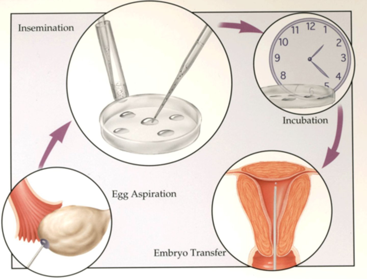 <p>method of fertilizing human ova outside the body and placing the zygote into the uterus</p>