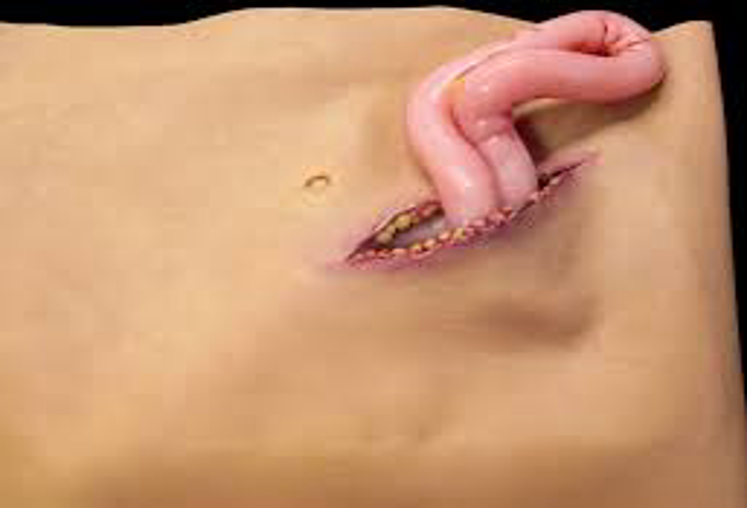 <p><span><span>Removal of internal organs or viscera from the body cavity</span></span></p>