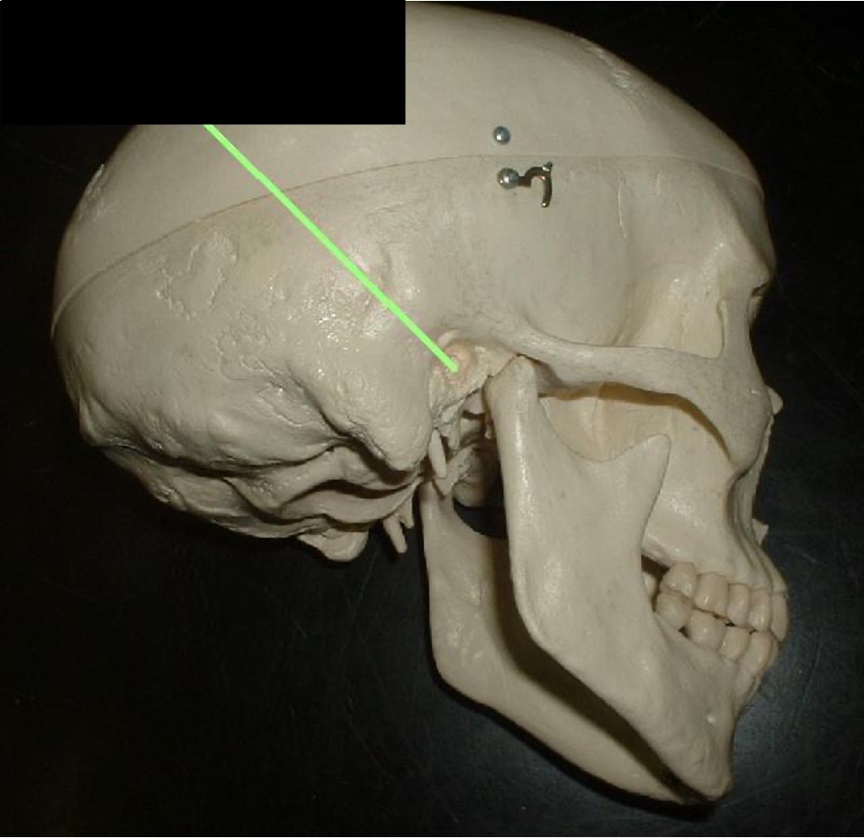 <p>the ear hole; it is in between the mastoid process and the zygomatic process</p>