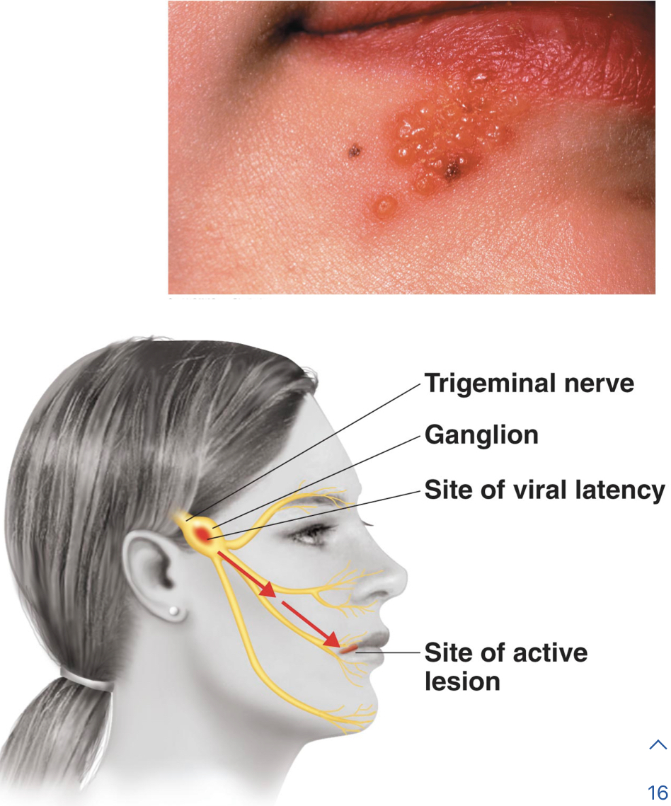 Cold sores/Fever blisters: Viral skin lesions