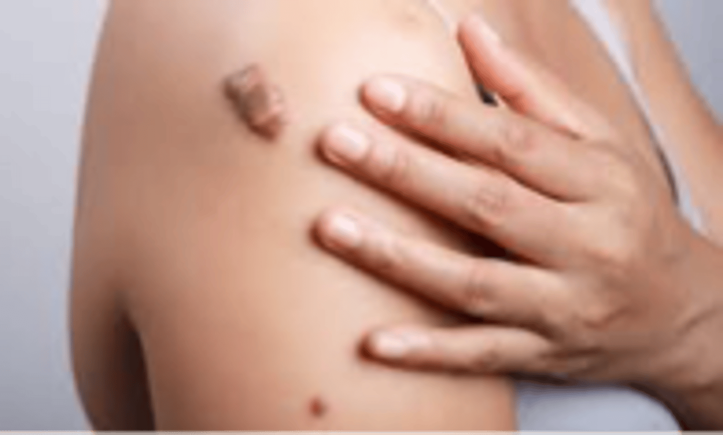 <p>Firm, hypertrophic mass of scar tissue that extends beyond the area of injury</p>