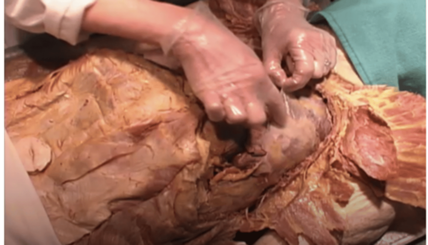 <p>Why might this region have areas that are a bit thicker?</p><p>Potential infection within the sac surrounding the lung</p><p>Potential infection of the clavicle</p><p>Potential infection of the leg</p><p>Potential infection of sac surrounding the the sternum</p>