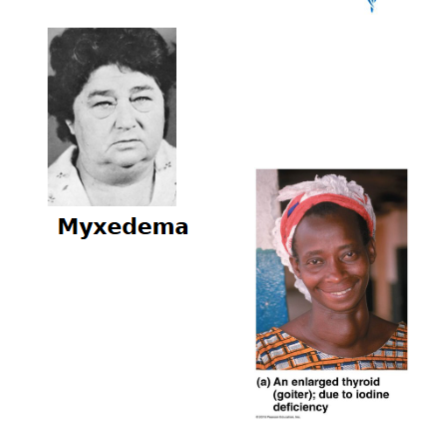 <ul><li><p>low metabolic rate</p></li><li><p> thick and/or dry skin</p></li><li><p>puffy eyes</p></li><li><p>feeling chilled</p></li><li><p> constipation</p></li><li><p>edema</p></li><li><p>mental sluggishness</p></li><li><p> lethargy</p></li></ul><p></p>