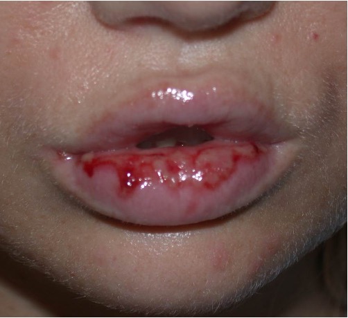 <p>superficial, focal loss of part of epidermis</p>