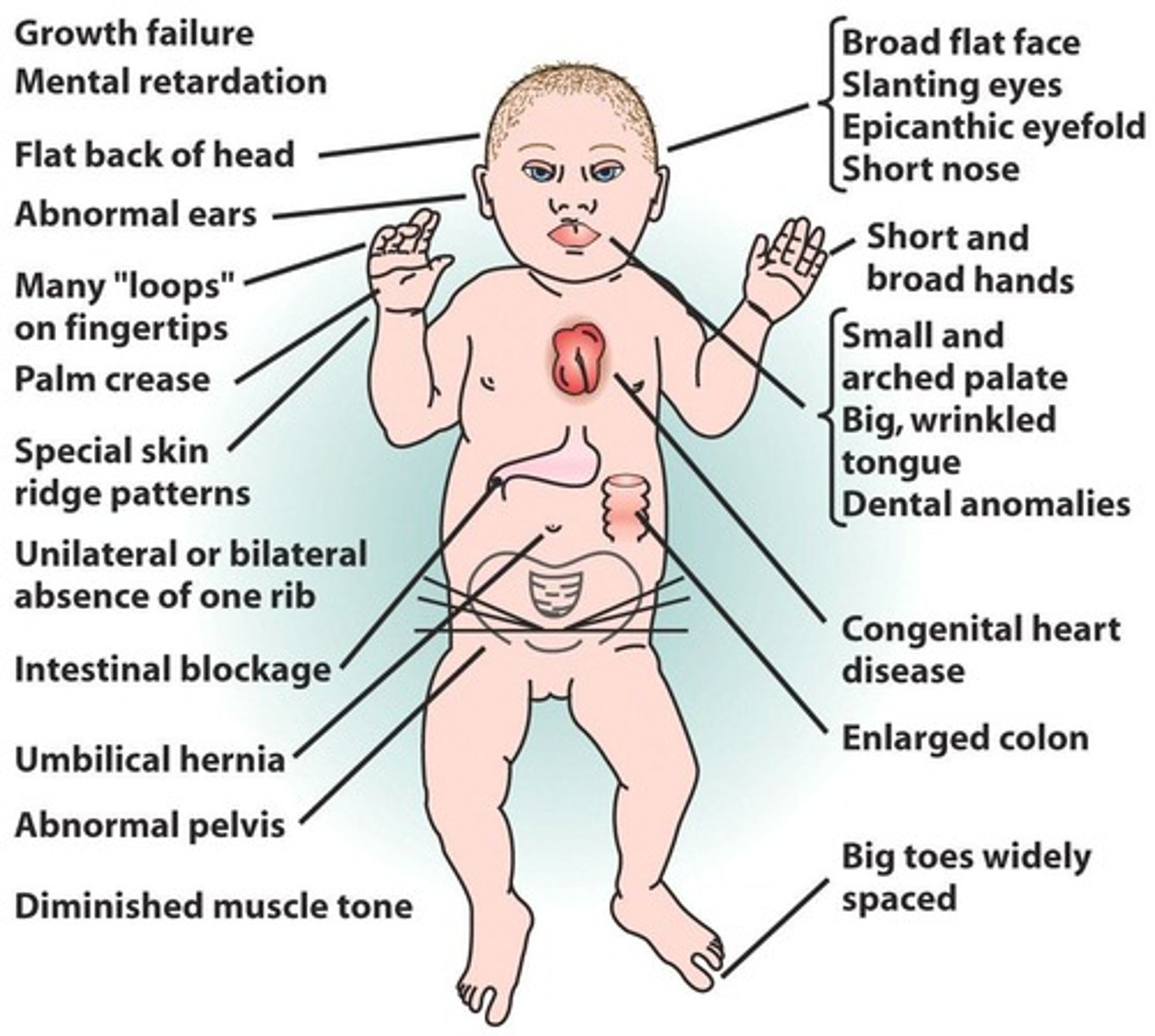 <p>Down's Syndrome.</p>