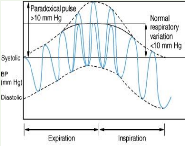 <p>Pressure of the pulse: no change</p><p>Contour: amplitude decreased with inspiration (10 mmHg+)</p><p>Causes: hypothyroidism, fluid in heart (pericardial tamponade, constrictive pericarditis, obstructive lung disease)</p>