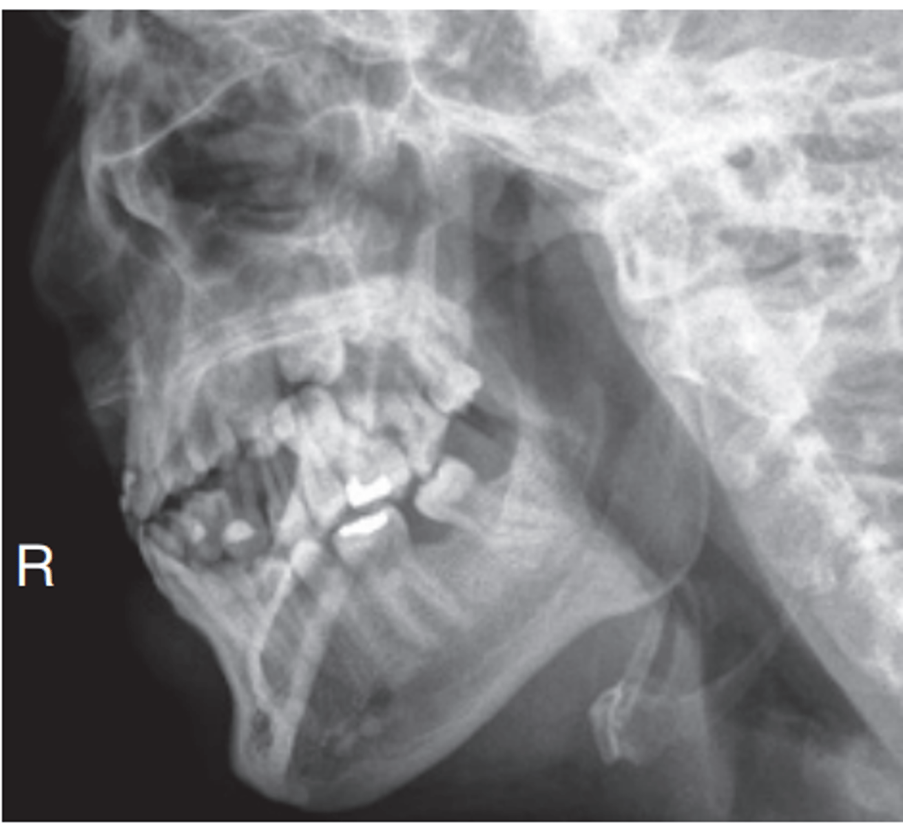 <p>-Position:</p><p>• The appearance of the image/position of the patient depends on the structures under examination.</p><p>• For the ramus and body, the ramus of interest is demonstrated with no superimposition from the opposite mandible (indicating correct CR angulation).</p><p>• No superimposition of the cervical spine by the ramus should occur (indicating sufficient extension of neck).</p><p>• The ramus and body should be demonstrated without foreshortening (indicating correct rotation of head).</p><p>• The area of interest is demonstrated with minimal superimposition and minimal foreshortening</p>