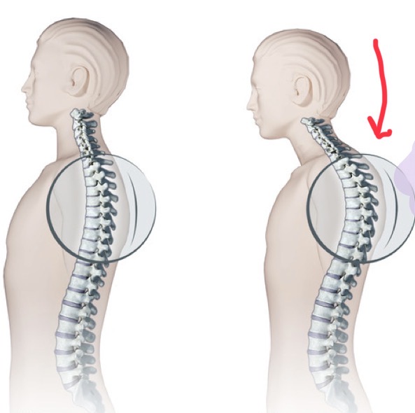 <p>An exaggerated rounding of the back, commonly known as 'hunchback'. Most often affects the thoracic region and in elderly people </p>