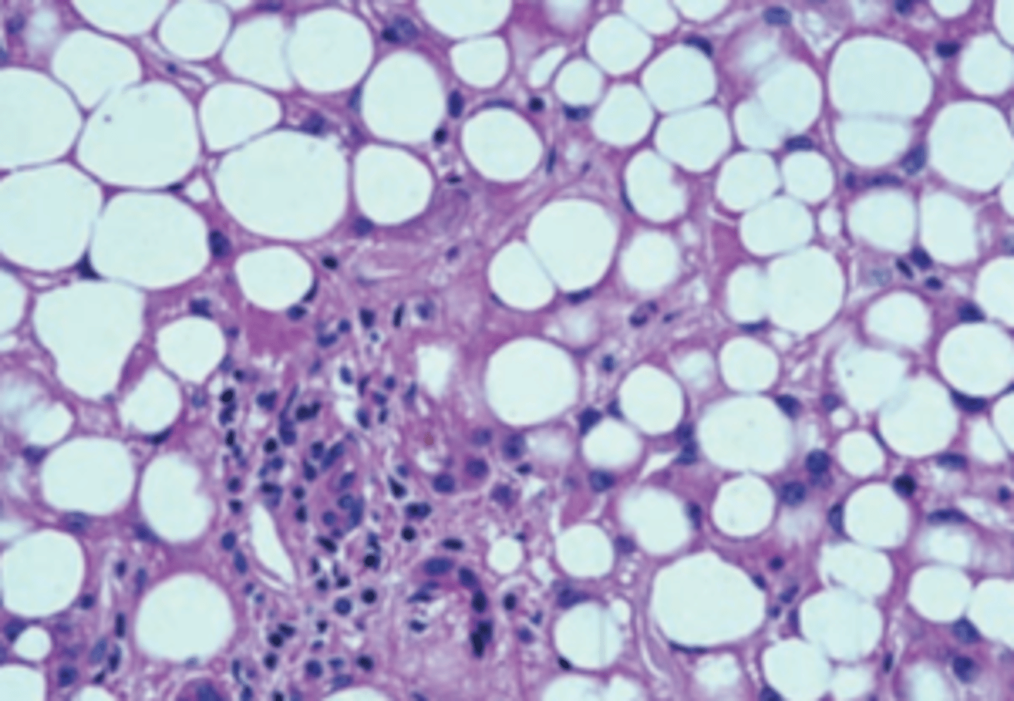 <p>A 60-year-old man has a 6-month history of abdominal swelling. On a daily basis, he smokes two packs of cigarettes, drinks ﬁve cups of coffee, and reports that he consumes 2 sixpacks of beer. Physical examination shows a distended abdomen with a palpable liver 2 cm below the costal margin. A liver biopsy is shown in the image. If this patient becomes abstinent, his liver will most likely do which of the following?</p><p>(A) Develop hepatocellular carcinoma</p><p>(B) Progress to cirrhosis</p><p>(C) Progress to inﬂammatory hepatitis</p><p>(D) Remain unchanged</p><p>(E) Revert to normal</p>