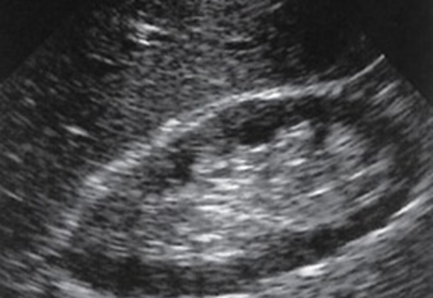 <p>Thinning of the cortex WNL: &gt;1cm</p>