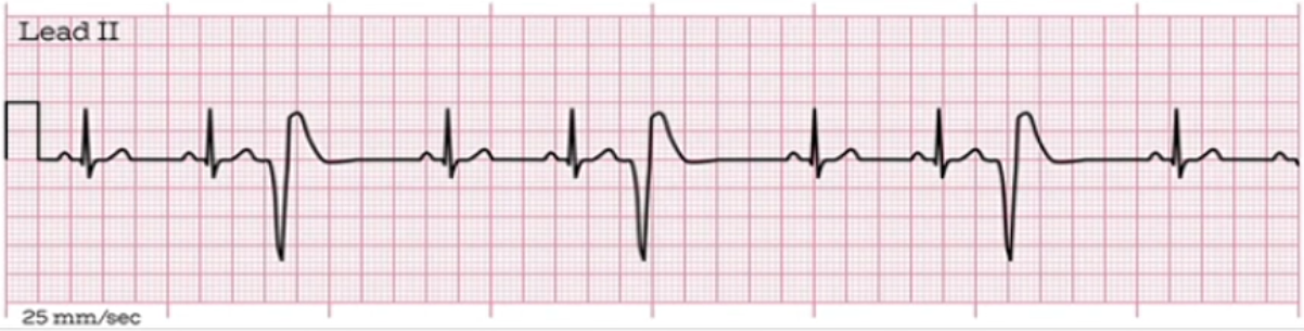 <p>What does this EKG represent?</p>