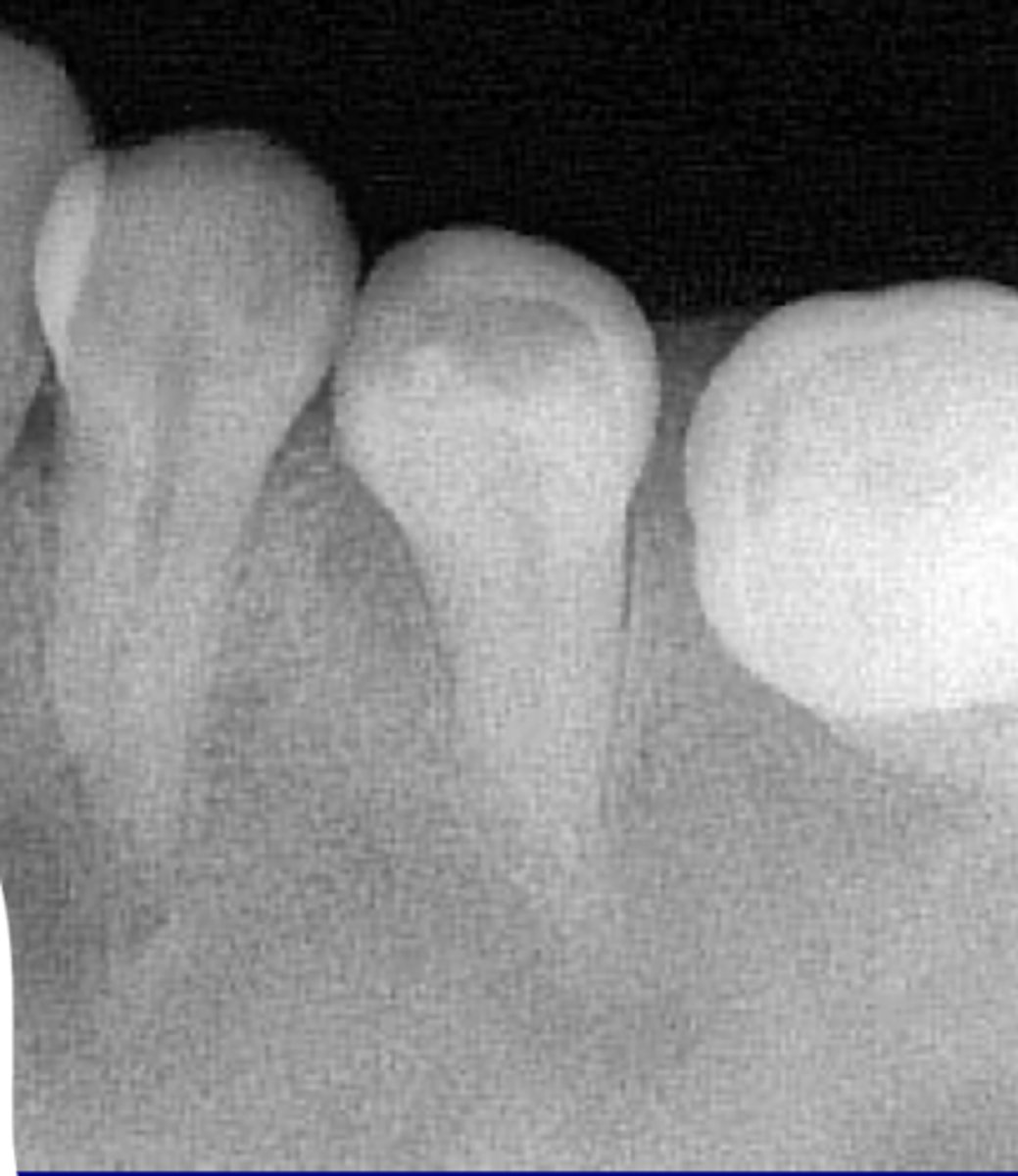 <p>Ground glass appearance of involved bone</p>