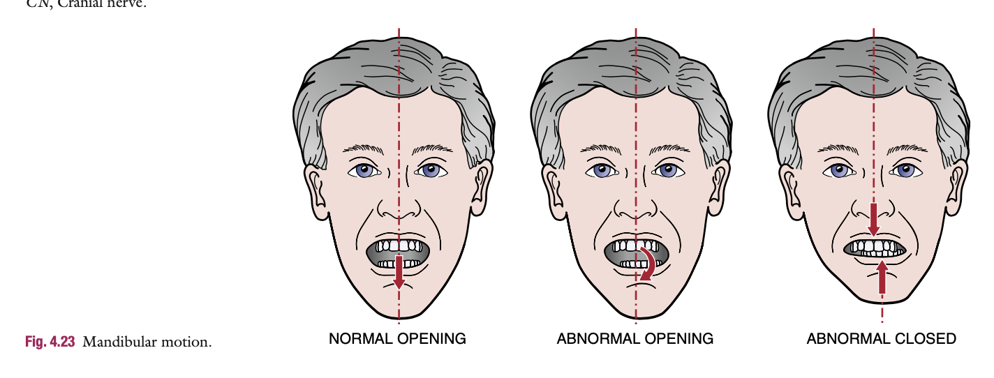 <p><strong>AROM : Phases of mouth opening</strong>:</p><ol><li><p><strong>First phase</strong>: Rotation of the mandible.</p><ul><li><p>Tested by having the patient open their mouth widely while keeping the tongue against the hard palate.</p></li><li><p>Minimal pain, even with acute TMJ dysfunction.</p></li></ul></li></ol><p></p>