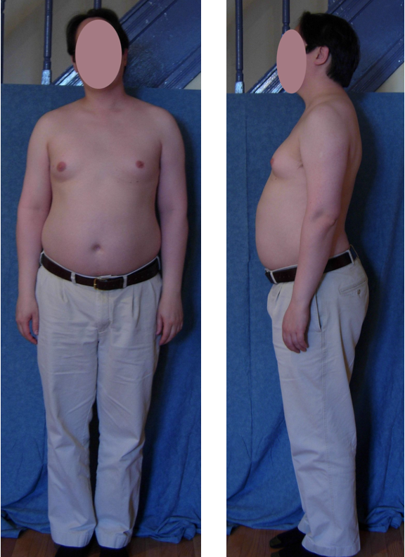 <p>The following clinical features are associated with what condition?</p><ul><li><p>“pear shaped mama’s boy”</p></li><li><p>long limbs, tall height </p></li><li><p>gynecomastia, hypogonadism, azoospermia</p></li></ul><p></p>