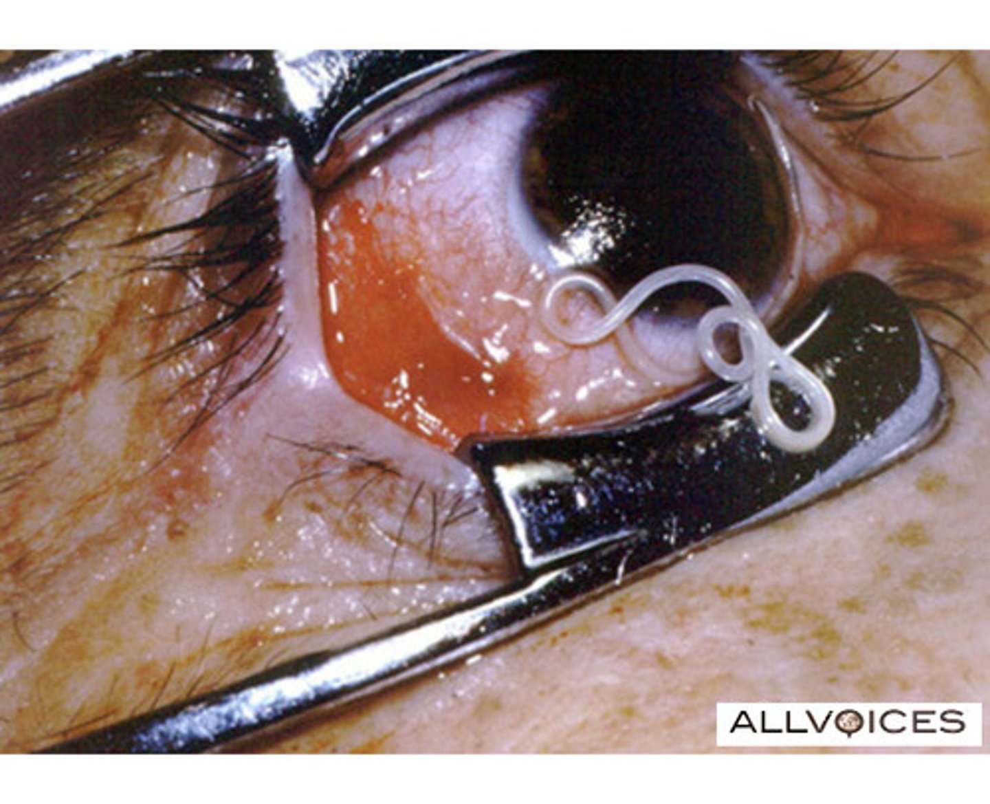 <p>: It causes Calabar swellings (localised itchy swellings) and visible migration of the adult worm across the conjunctiva (surface of the eye).</p>