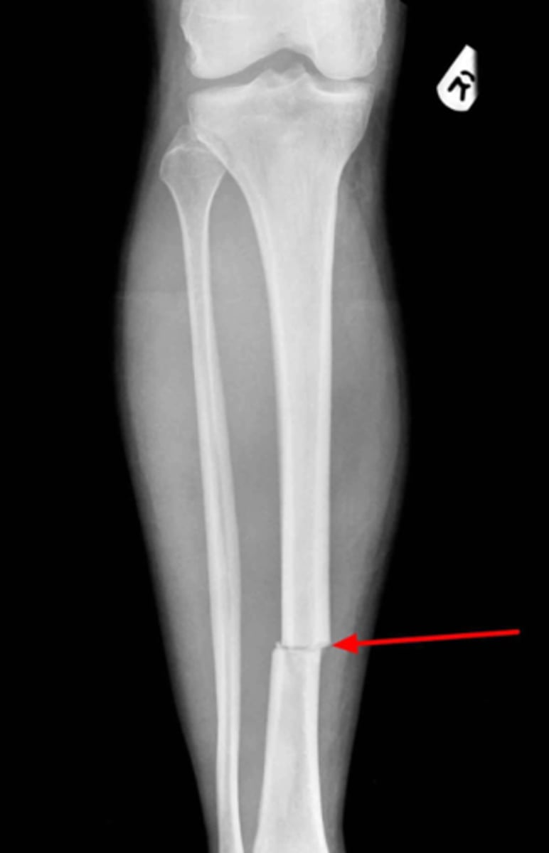 <p>What type of fracture is this?</p>