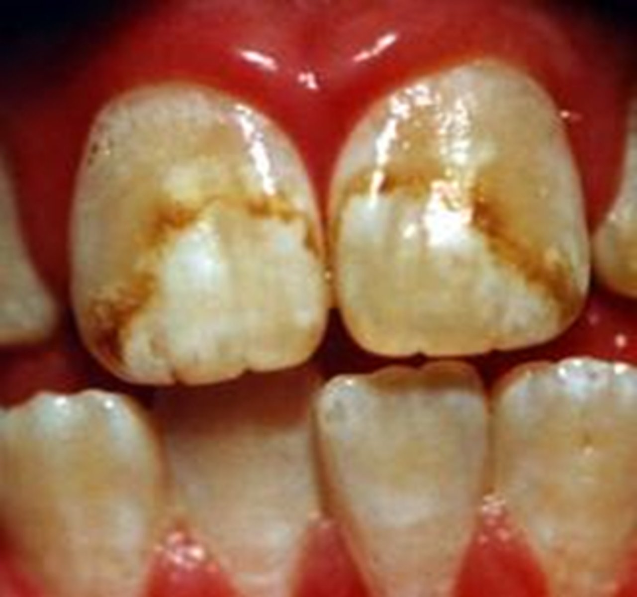 <p>hypocalcified teeth</p>
