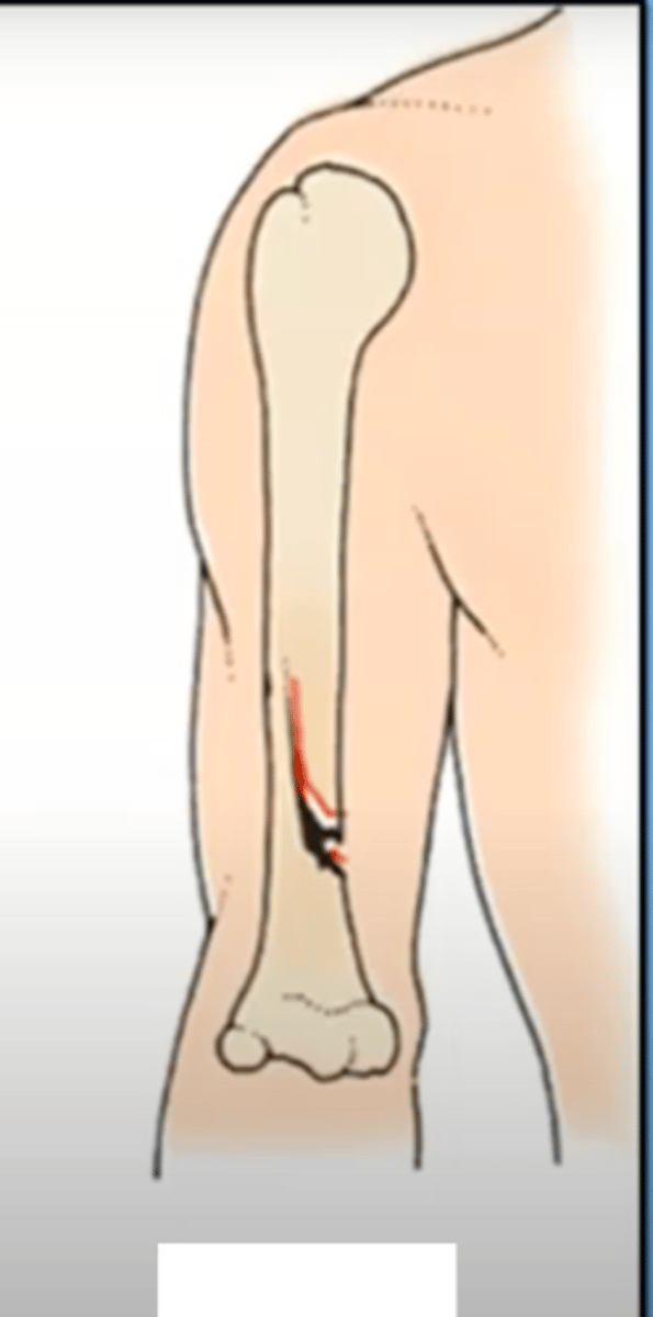 <p>a fracture with an incomplete break, the bone bends, seen more in kids with more pliable bones</p>