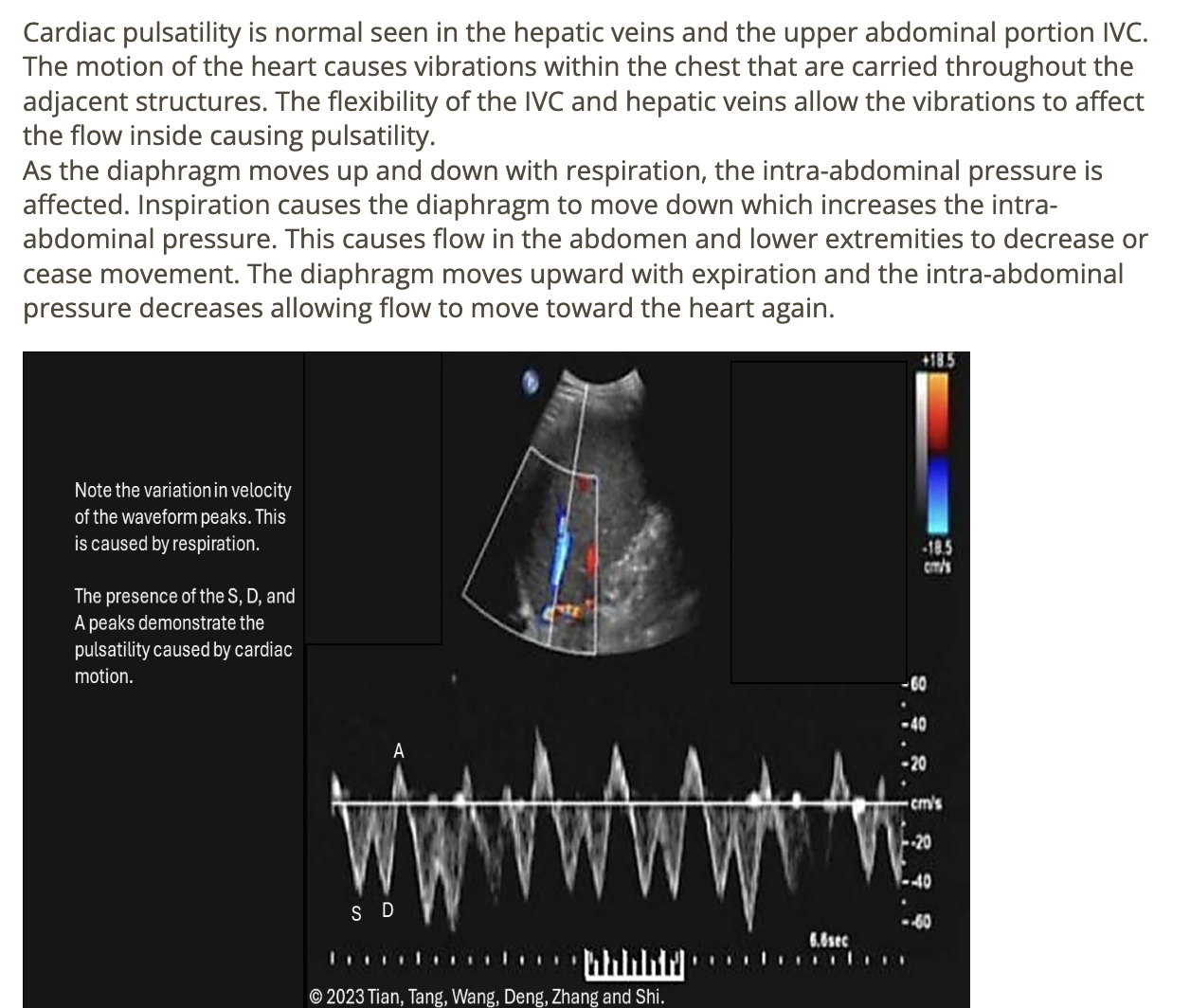 <p>d) cardiac pulsatility + respiratory phasicity </p>