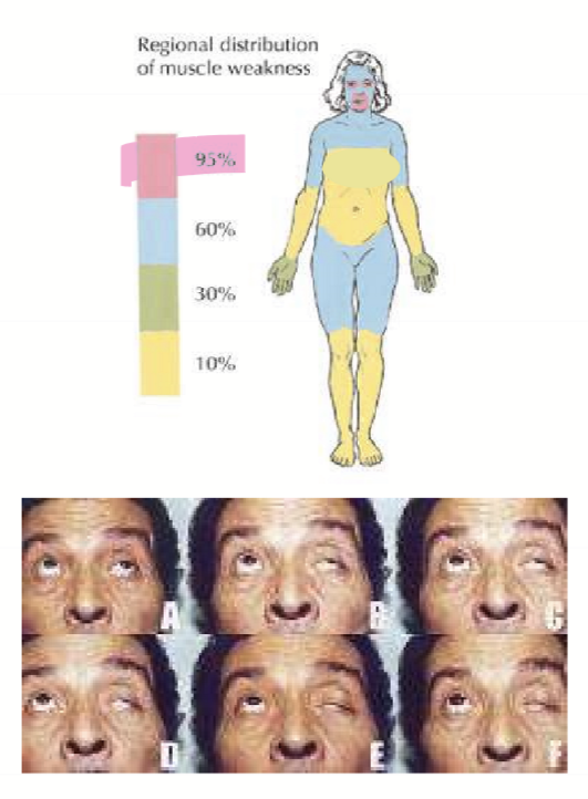 <ul><li><p>first affects eyes and mouth: </p><ul><li><p>ptosis</p></li><li><p>diplopia</p></li><li><p>dysphagia (difficulty eating)</p></li><li><p>Difficulty talking </p></li></ul></li><li><p>Later effects neck, hips, and shoulders</p></li></ul><p></p>