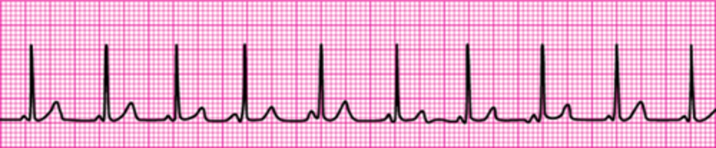 <p>Pulseless electrical activity</p>