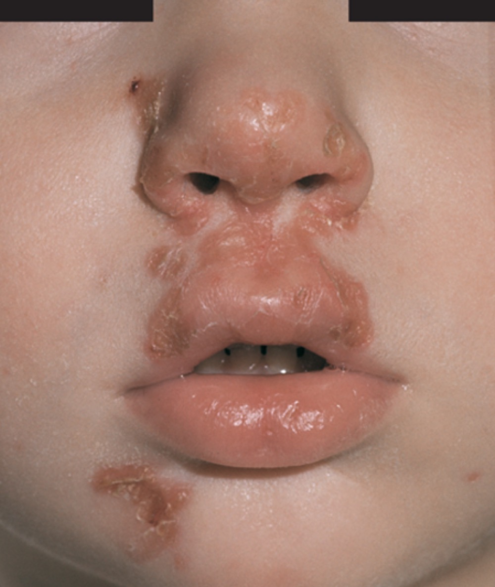 What is this called?

A. Cellulitis

B. Impetigo

C. Positive TB test

D. Bullseye lesion