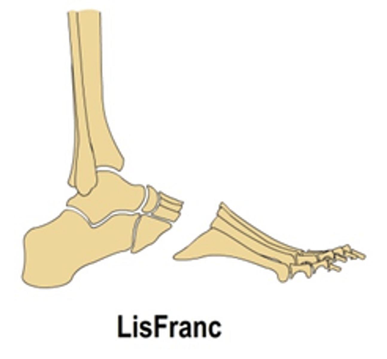 <p>Lisfranc</p>