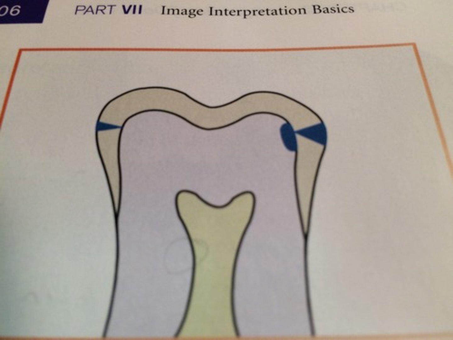 <p>extends to or through the DEJ and into dentin</p>