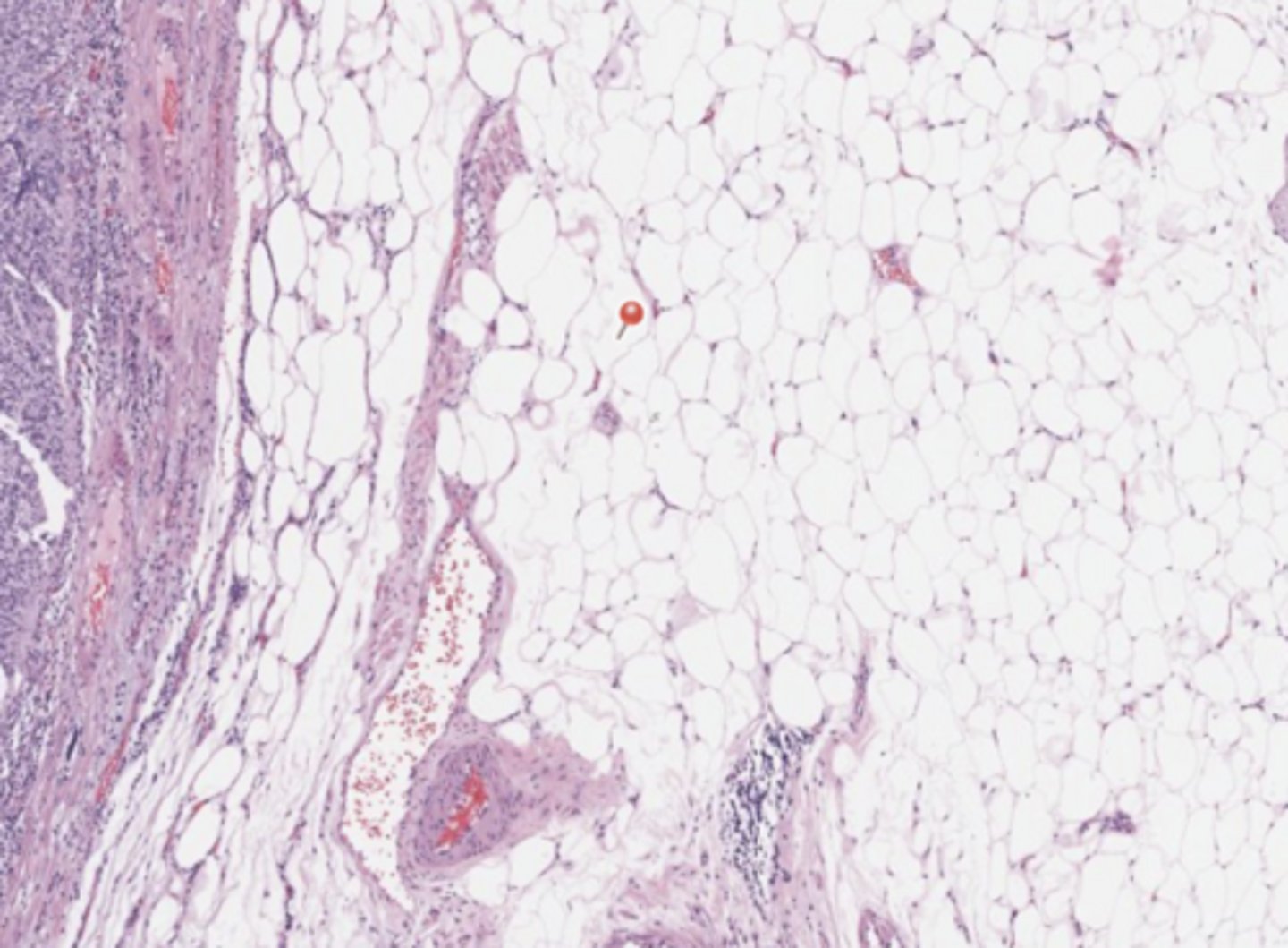 <p>Urothelial tract</p>