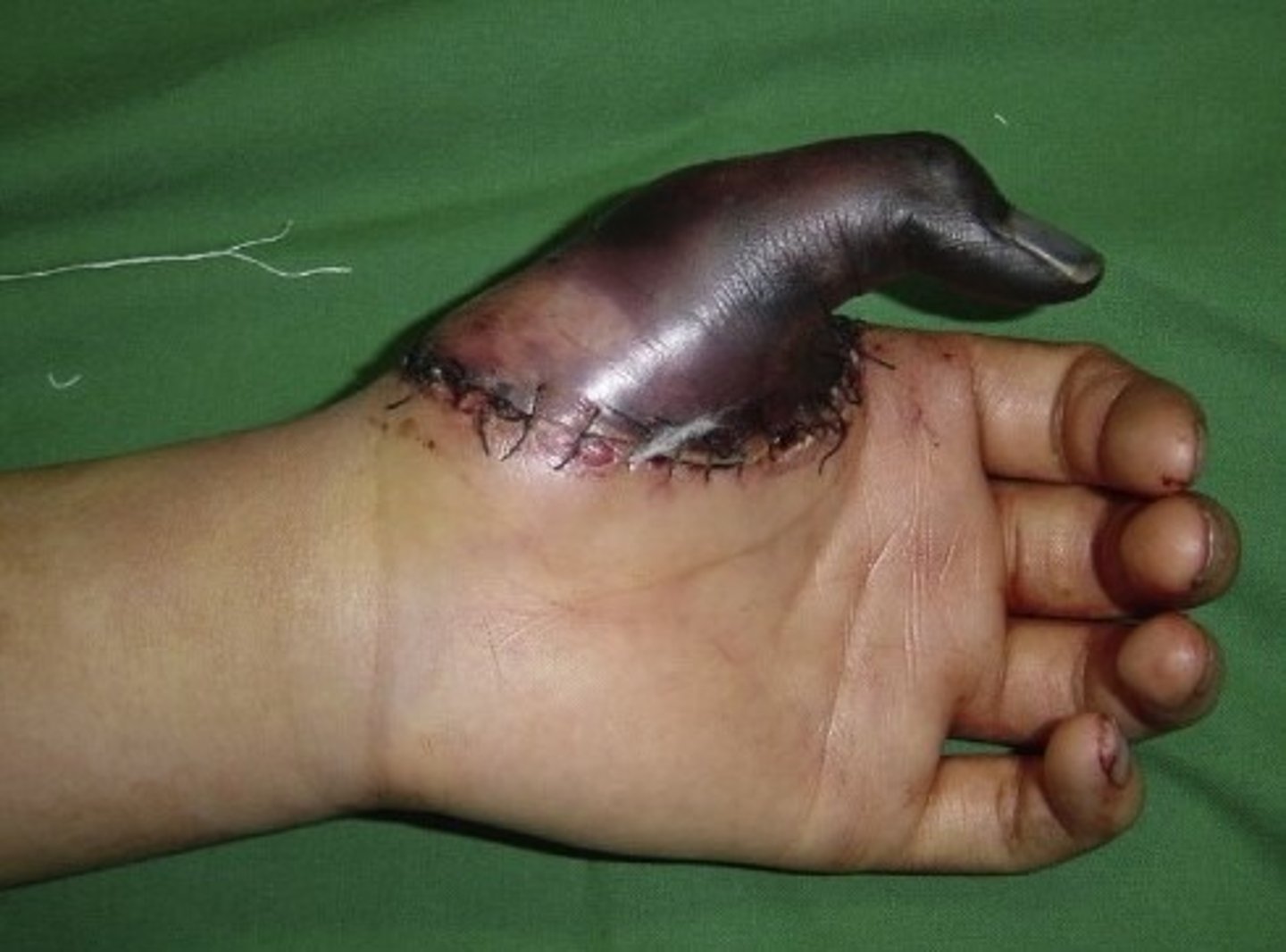 <p>wound caused by force leading to compression or disruption of tissues</p>