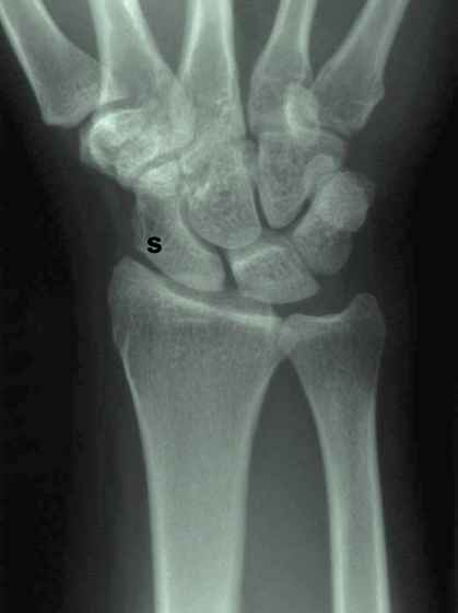 <p>-Navicular</p><p>-also one on the foot</p><p>-Commonly Fractured</p>