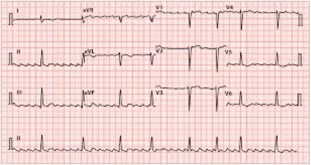 <p>What does this refer “Sawtooth flutter waves, typically regular”</p>