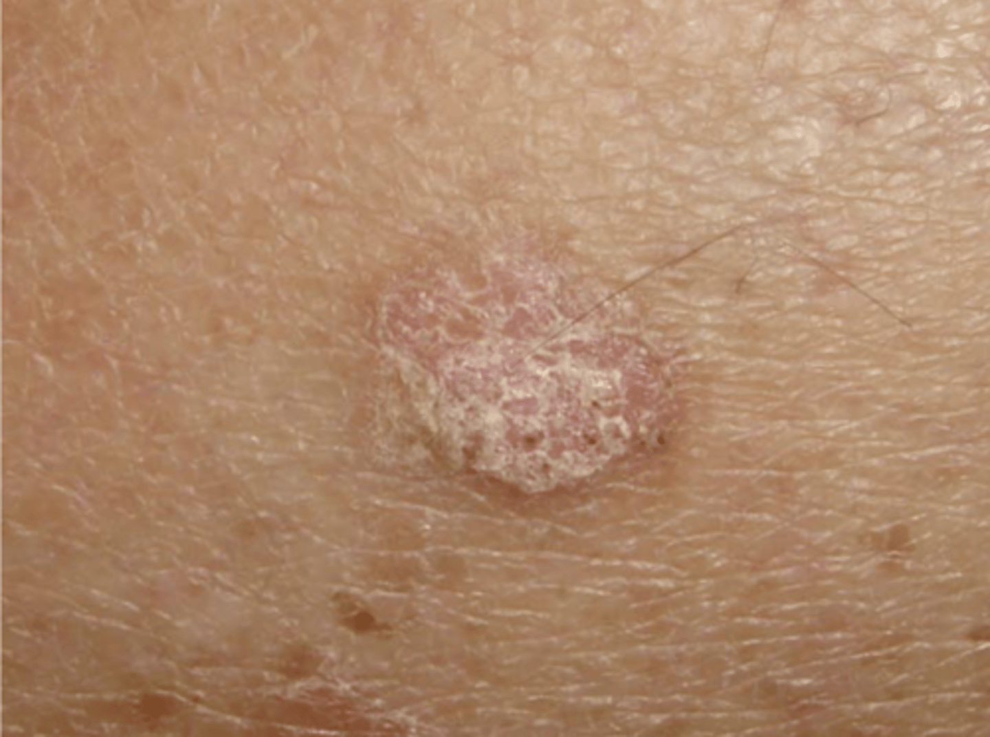 <p>Actinic keratosis, also known as solar keratosis, is a premalignant skin condition</p>