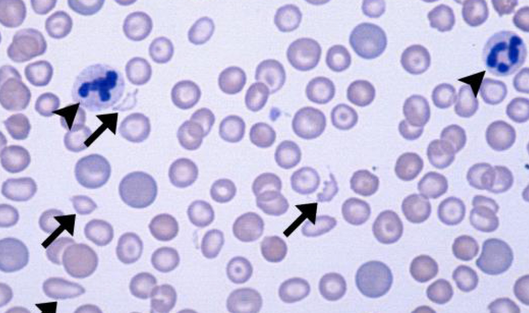Name this RBC Abnormality.