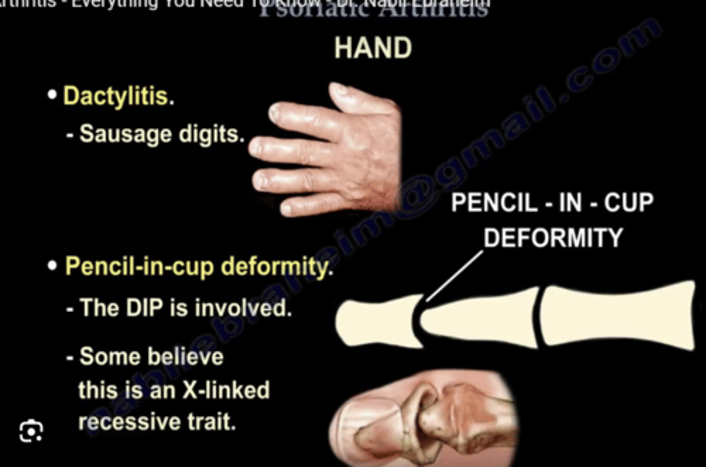 <p>X-ray</p><p>- unusual combination of erosive changes (resorption) and new bone formation</p><p>- "pencil in cup" deformity</p><p>- arthritis mutilans (looks really deformed)</p><p>- dactylitis = self limiting episode of a swollen digit</p><p>- rash on extensor surfaces</p><p>'Rheumatoid'-like joint problems but nail changes → ?psoriatic arthritis</p>