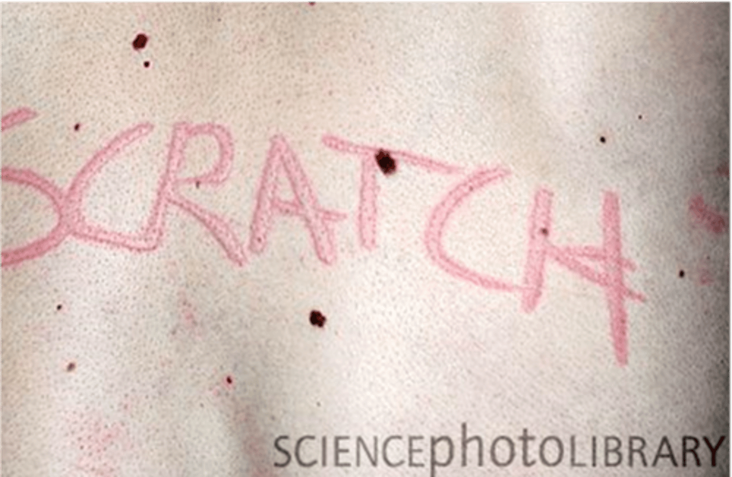 <p>___________________:</p><p>• "writing on the skin”. It is a very common localized hive reaction.</p>